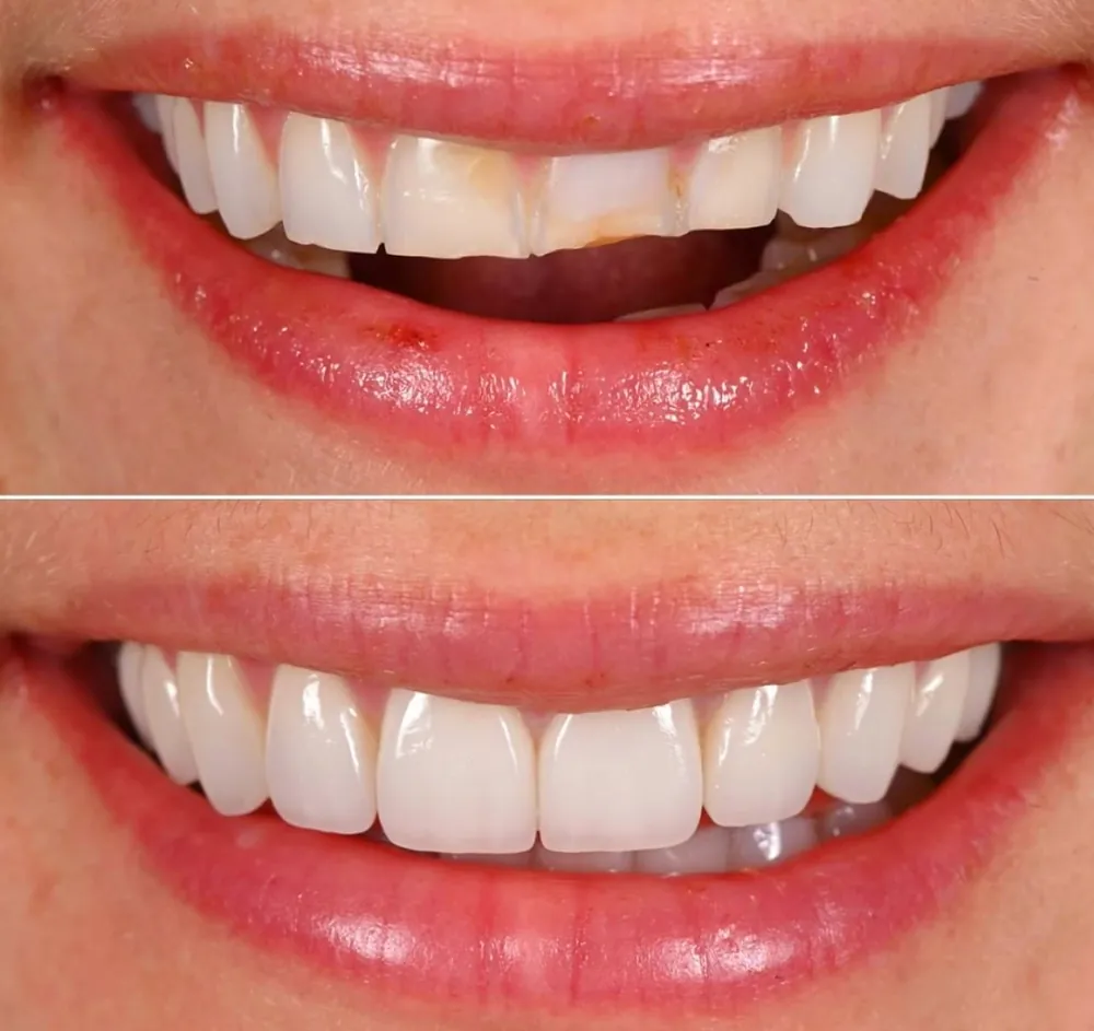 Antes e depois: dentes da frente com fratura e desgaste, restaurados com laminados cerâmicos