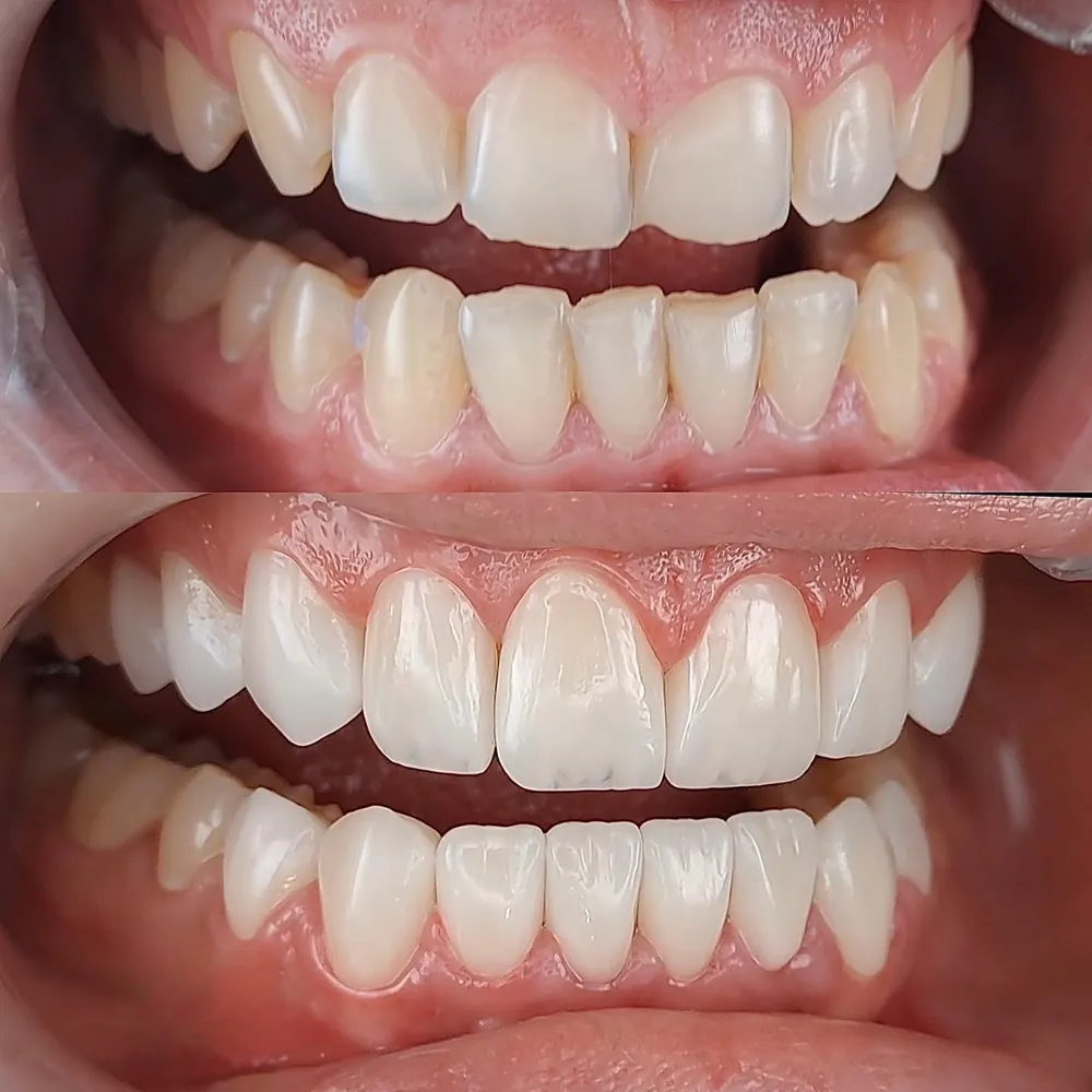 Antes e depois: laminados cerâmicos nos dentes superiores e inferiores
