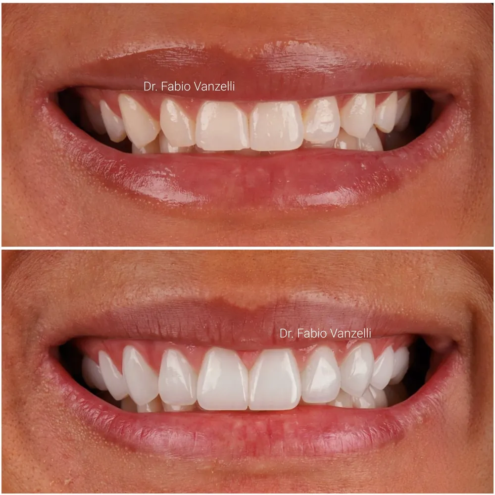 Antes e depois: sorriso com dentes desalinhados, restaurado com lentes de contato cerâmicas