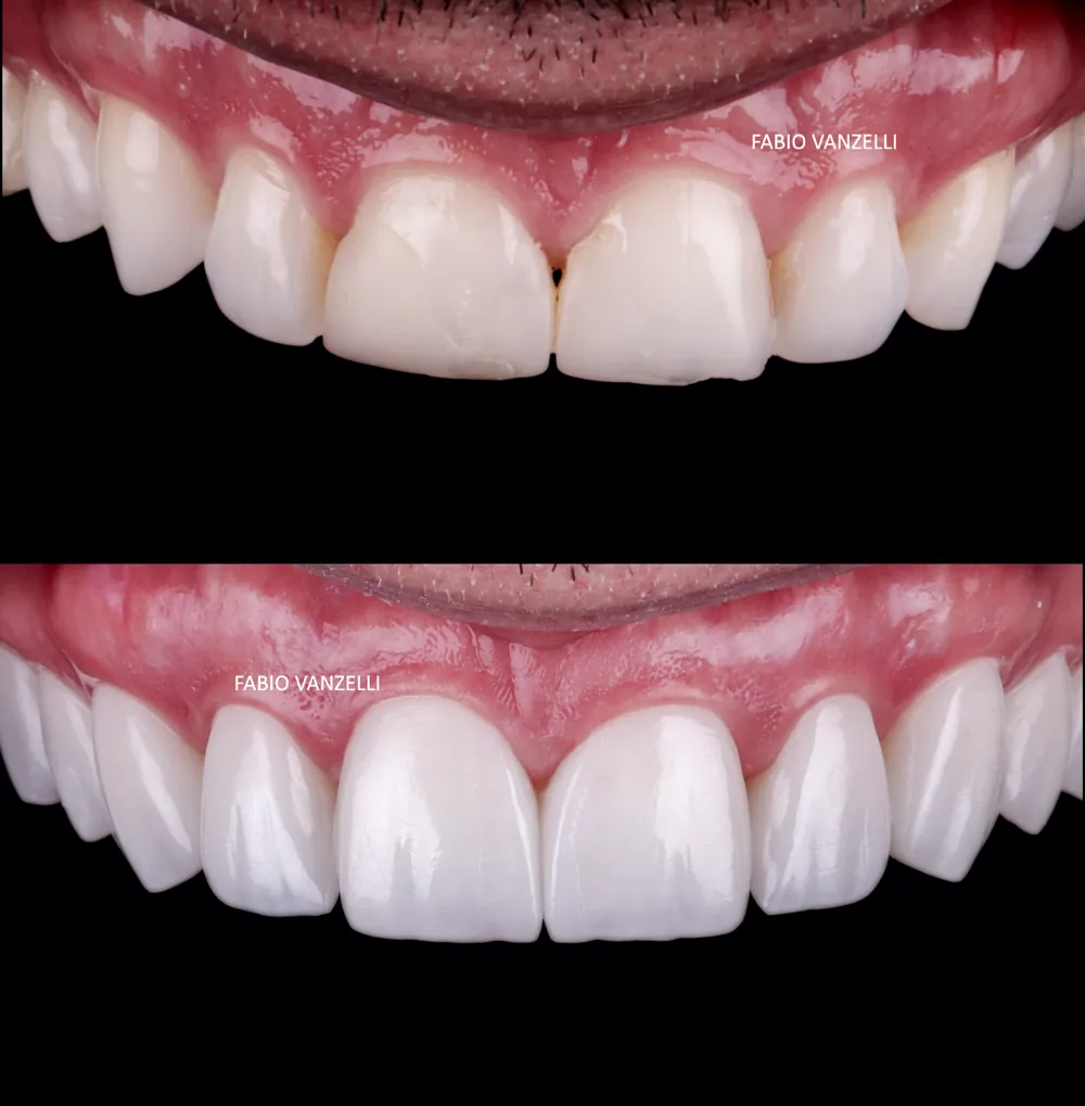 Antes e depois: dentes anteriores com desgaste e fraturas, restaurados com laminados cerâmicos