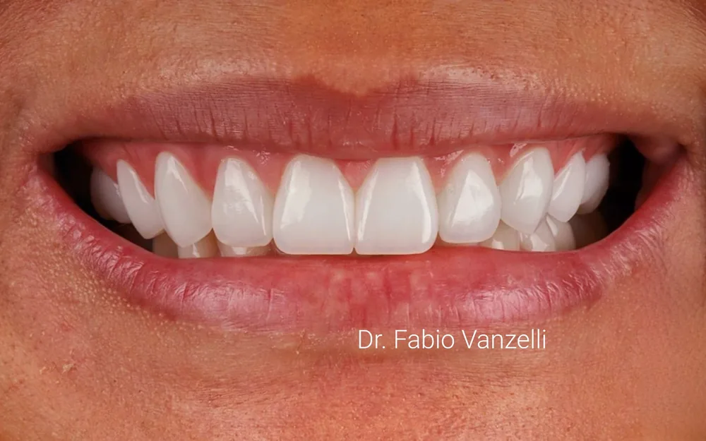Sorriso aberto com lentes de contato cerâmicas, assinado pelo Dr. Fabio Vanzelli