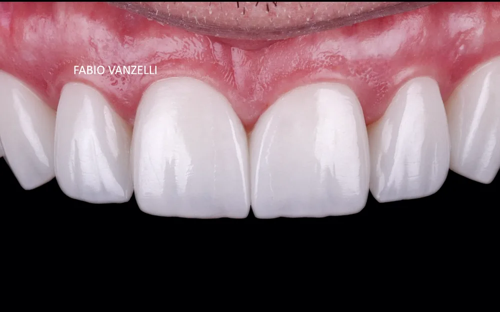 Dentes superiores com laminados cerâmicos sobre fundo preto, assinados pelo Dr. Fabio Vanzelli