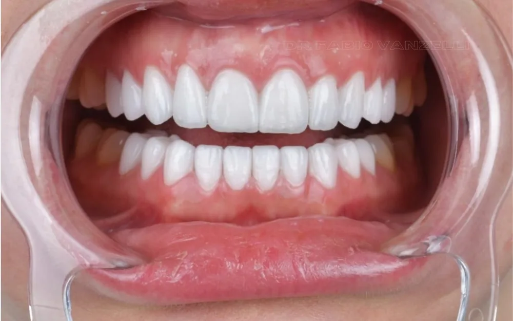 Sorriso com laminados cerâmicos nos dentes superiores e inferiores