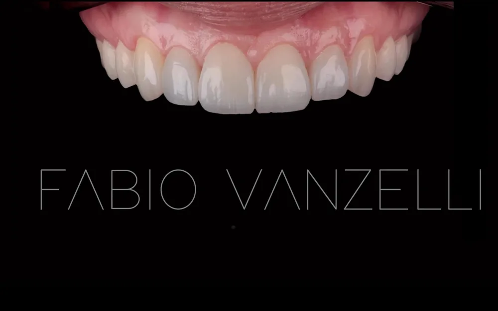 Vista lateral dos dentes superiores com laminados cerâmicos, assinada pelo Dr. Fabio Vanzelli